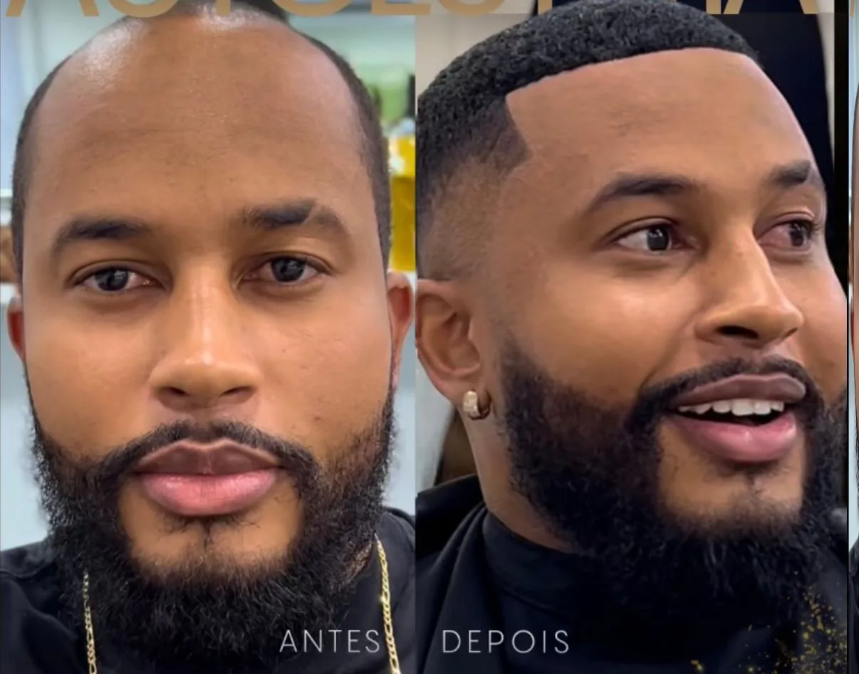 Antes e depois de um cliente da GÜVEN após aplicação de prótese capilar.